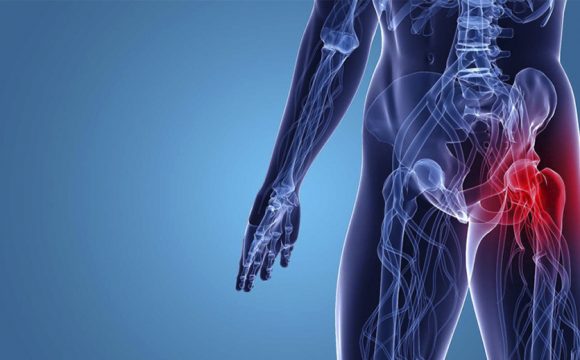 Artrosi D’anca, Sintomi e Trattamento Fisioterapico