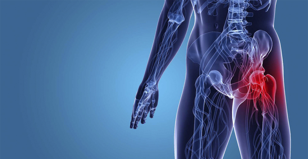 Artrosi D’anca, Sintomi e Trattamento Fisioterapico
