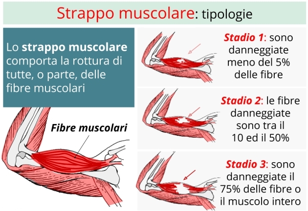Strappo muscolare